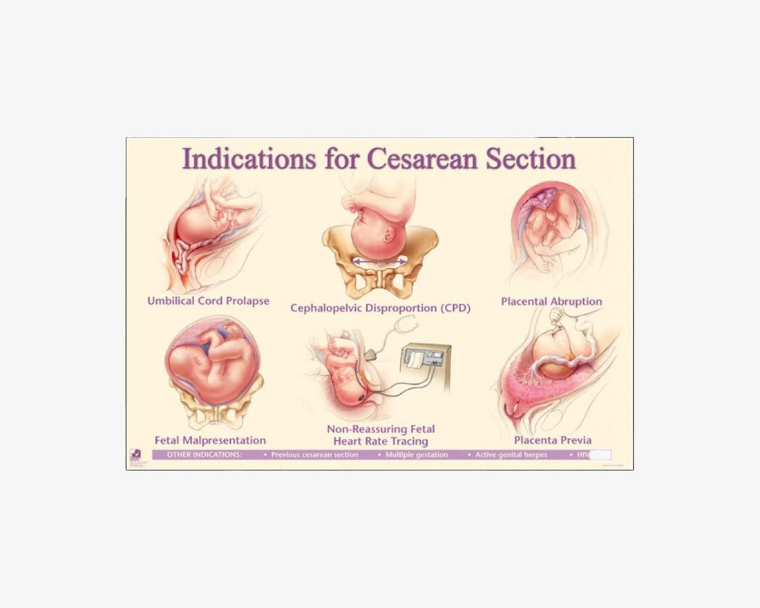Poster: Indikationen für einen Kaiserschnitt (englisch)
