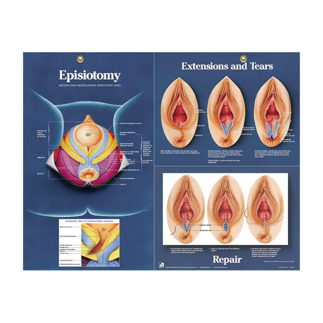 Poster: Episiotomie (englisch)