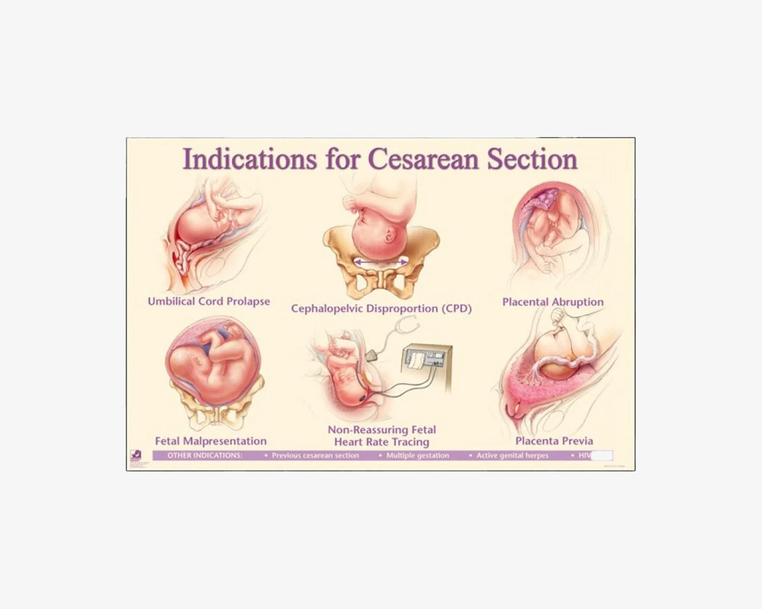 Indikationen für einen Kaiserschnitt Poster