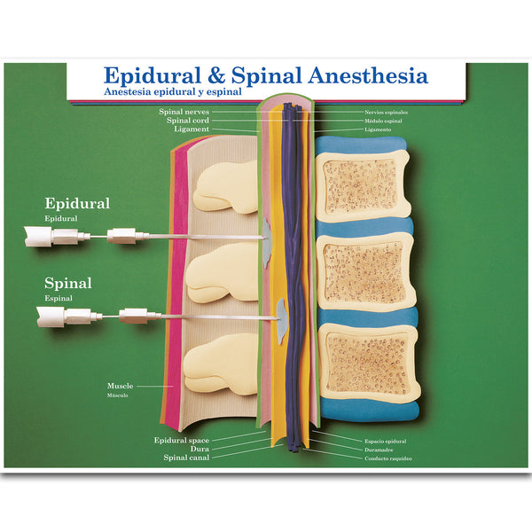 Epidural- und Spinal Anästhesie Poster