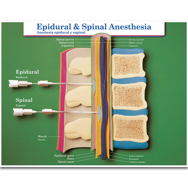 Epidural- und Spinal Anästhesie Poster